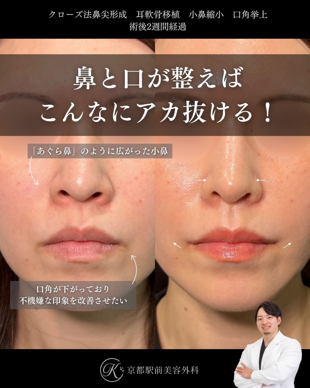 鼻と口が整うとこんなに垢抜ける！クローズ法の鼻尖形成、耳軟骨移植、小鼻縮小内外側法、口角挙上の症例（京都駅前美容外科の症例写真）当院は滋賀、京都、大阪をはじめとした関西圏や全国から患者様にお越しいただいています。