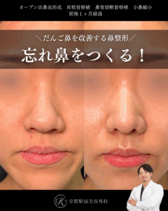 忘れ鼻を作る。鼻尖形成、耳軟骨移植、小鼻縮小の症例。（京都駅前美容外科の症例）当院は滋賀、京都、大阪をはじめとした関西圏や全国から患者様にお越しいただいています。