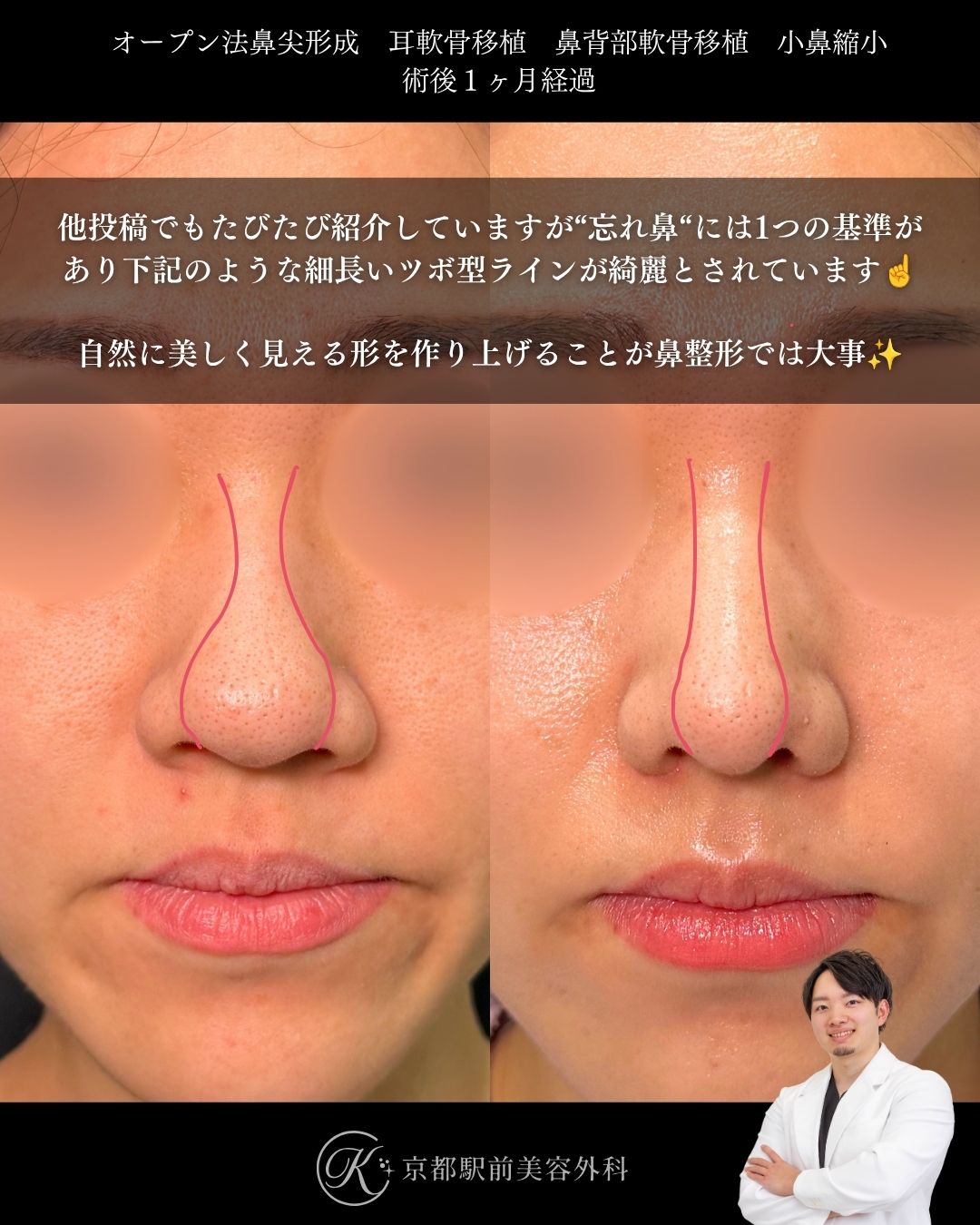 自然な忘れ鼻はこれ。鼻尖形成、耳軟骨移植、プロテーゼの症例。（京都駅前美容外科の症例）当院は滋賀、京都、大阪をはじめとした関西圏や全国から患者様にお越しいただいています。