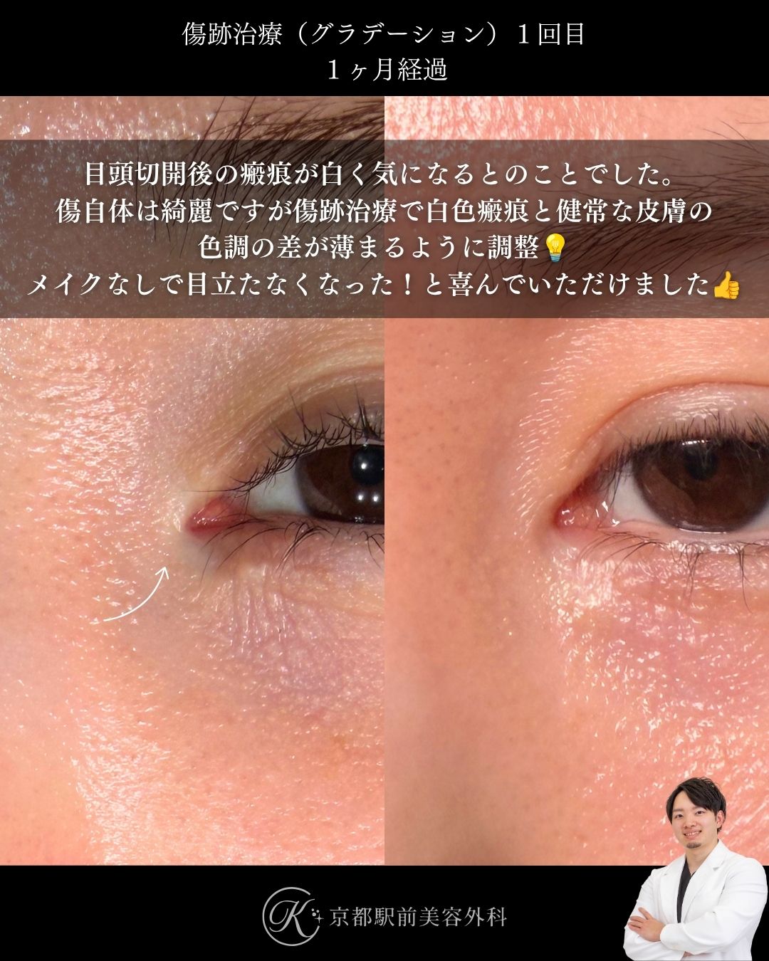傷跡治療・傷跡修正（グラデーション治療）の症例画像。目頭切開によりできた傷跡や瘢痕の写真など（京都駅前美容外科の症例写真）当院は滋賀、京都、大阪をはじめとした関西圏や全国から患者様にお越しいただいています。
