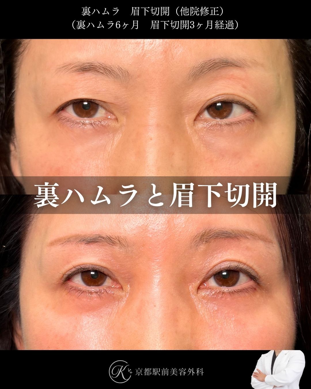 裏ハムラと眉下切開(他院修正)の症例。京都駅前美容外科の症例画像。当院は滋賀、京都、大阪をはじめとした関西圏や全国から患者様にお越しいただいています。
