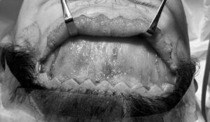 前頭筋が全体的に見えている様子。ここに割を入れることで不動化させます。京都駅前美容外科。