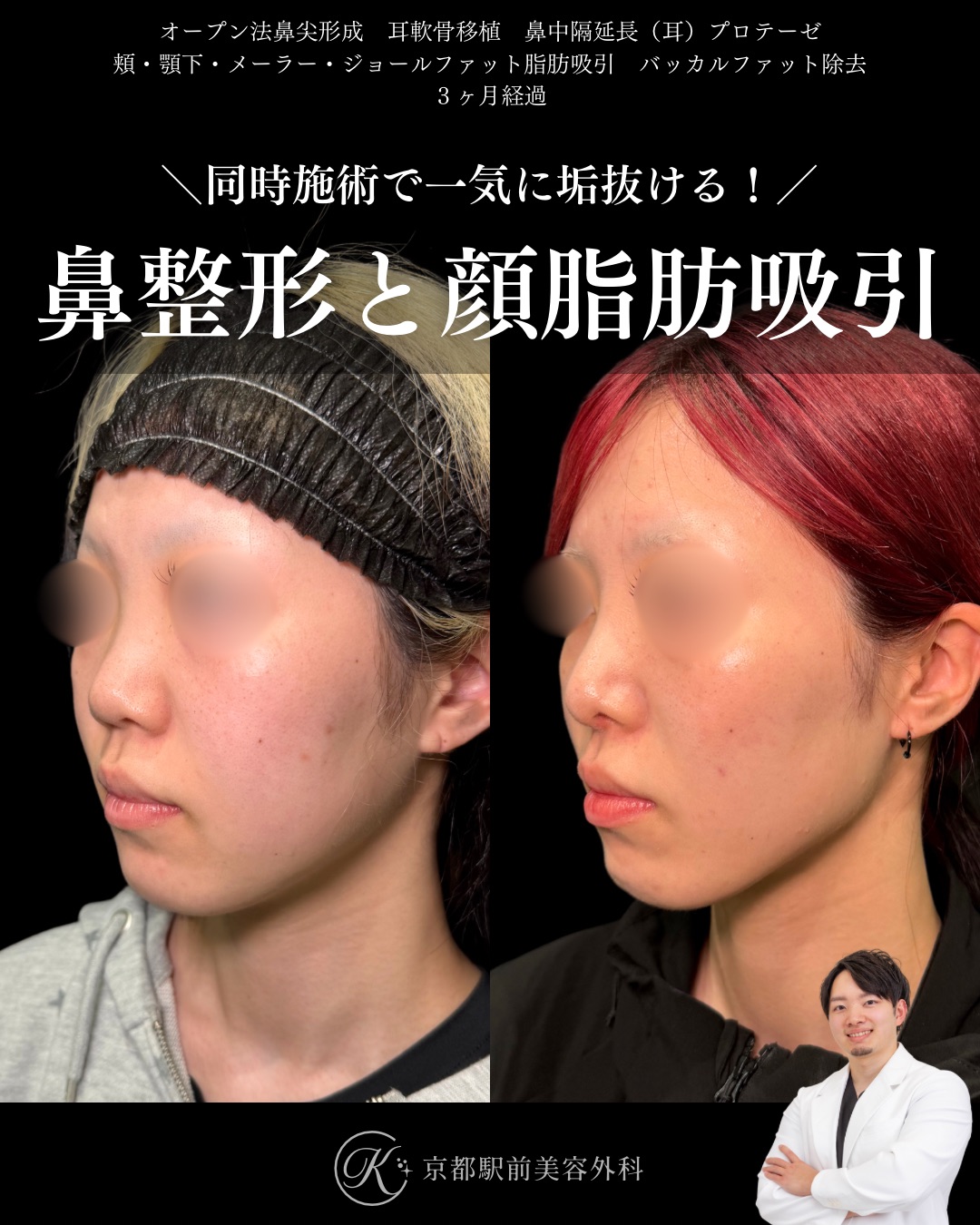 鼻整形と顔の脂肪吸引!鼻尖形成、耳軟骨移植、鼻中隔延長、頬顎下脂肪吸引、メーラーファット、ジョールファット除去、バッカルファット除去の京都駅前美容外科の症例写真。当院は滋賀、京都、大阪をはじめとした関西圏や全国から患者様にお越しいただいています。