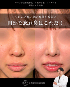 自然な忘れ鼻はこれだ。鼻尖形成、耳軟骨移植、プロテーゼの症例。（京都駅前美容外科の症例）当院は滋賀、京都、大阪をはじめとした関西圏や全国から患者様にお越しいただいています。