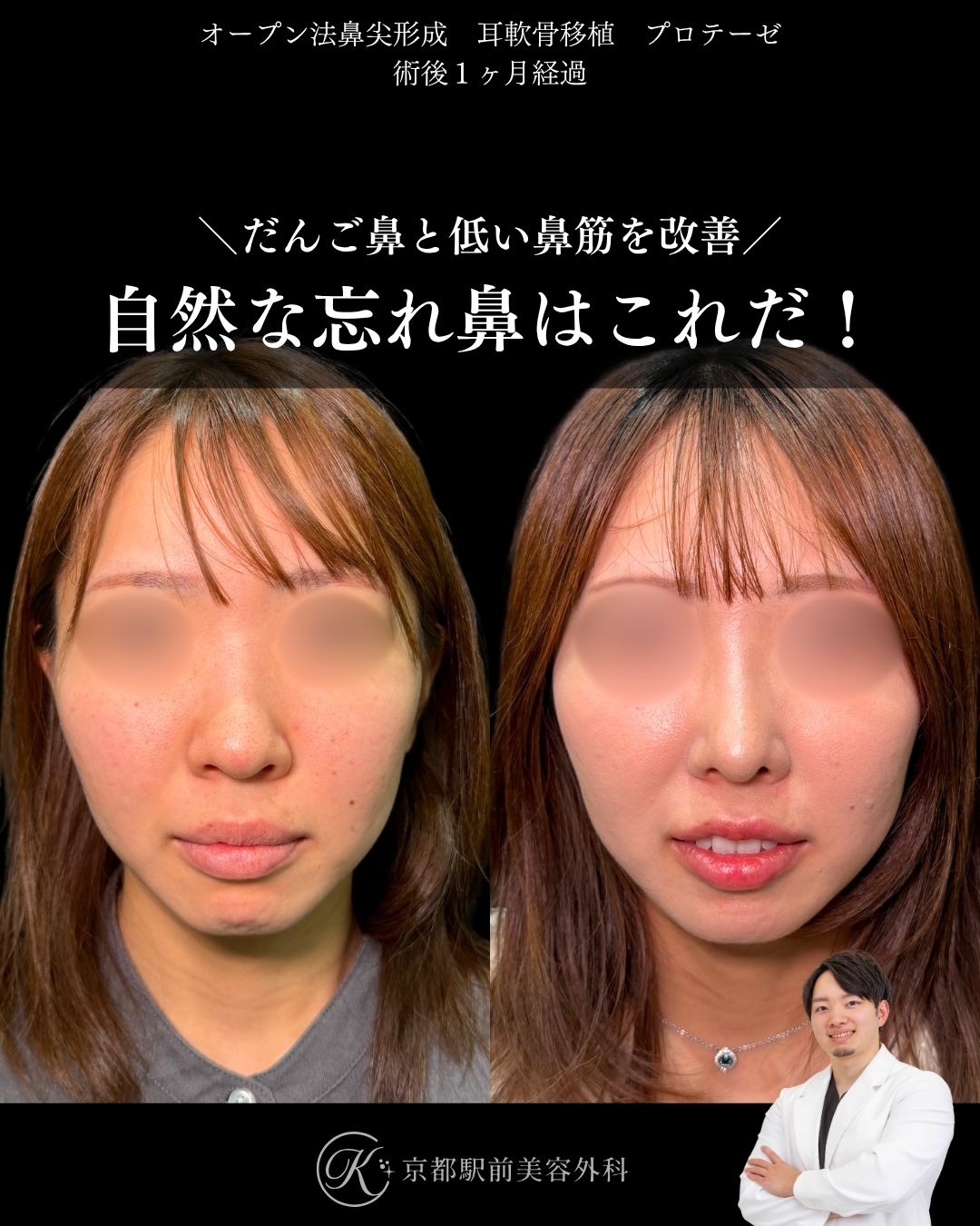 自然な忘れ鼻はこれ。鼻尖形成、耳軟骨移植、プロテーゼの症例。(京都駅前美容外科の症例)当院は滋賀、京都、大阪をはじめとした関西圏や全国から患者様にお越しいただいています。