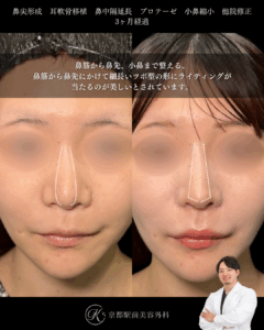 鼻のバランスを整えて骨切りと他院鼻中隔延長術後の低くなった鼻を美しく戻す。鼻尖形成、耳軟骨移植、鼻中隔延長、プロテーゼ、小鼻縮小、他院修正など（京都駅前美容外科の症例）当院は滋賀、京都、大阪をはじめとした関西圏や全国から患者様にお越しいただいています。