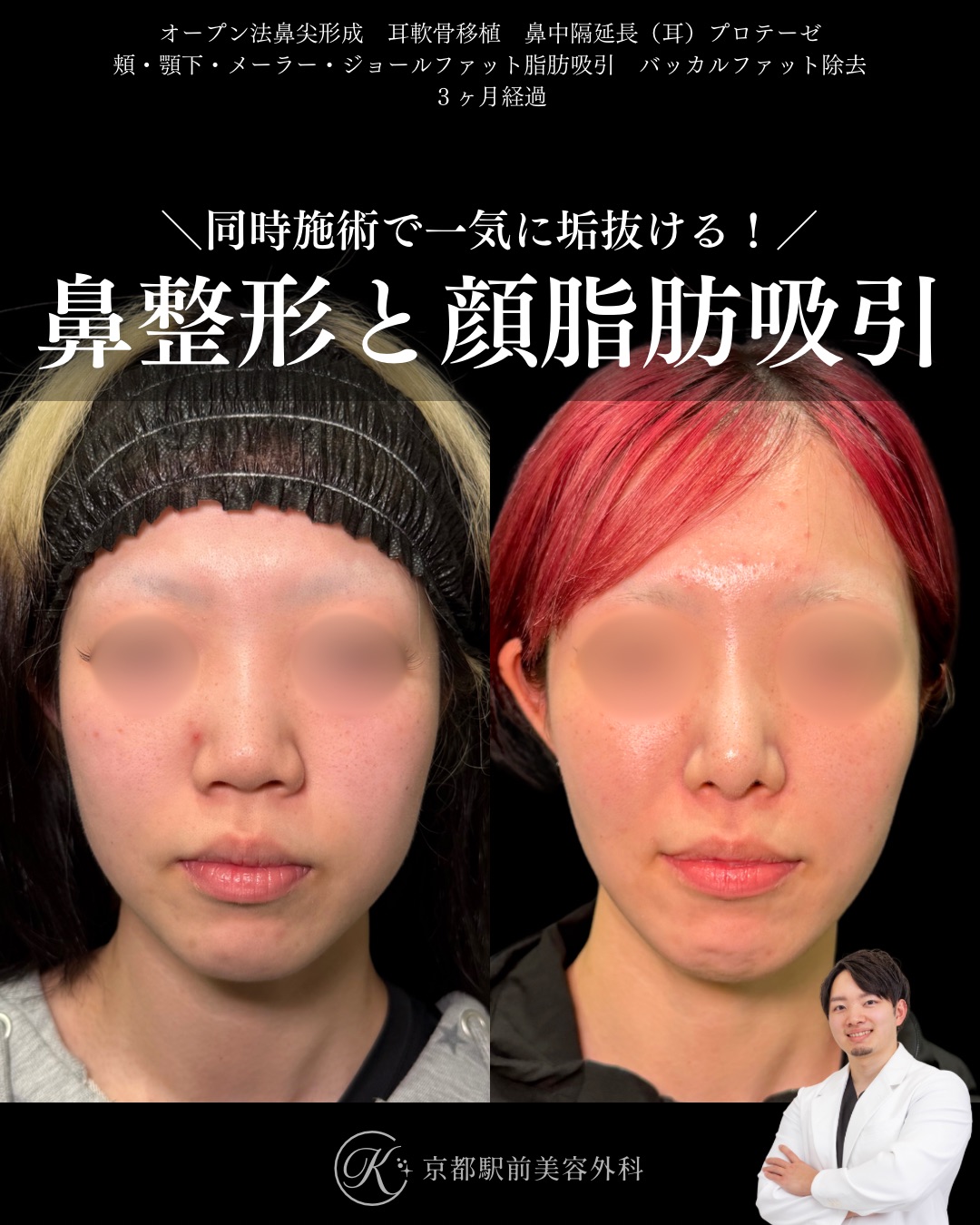 鼻整形と顔の脂肪吸引!鼻尖形成、耳軟骨移植、鼻中隔延長、頬顎下脂肪吸引、メーラーファット、ジョールファット除去、バッカルファット除去の京都駅前美容外科の症例写真。当院は滋賀、京都、大阪をはじめとした関西圏や全国から患者様にお越しいただいています。
