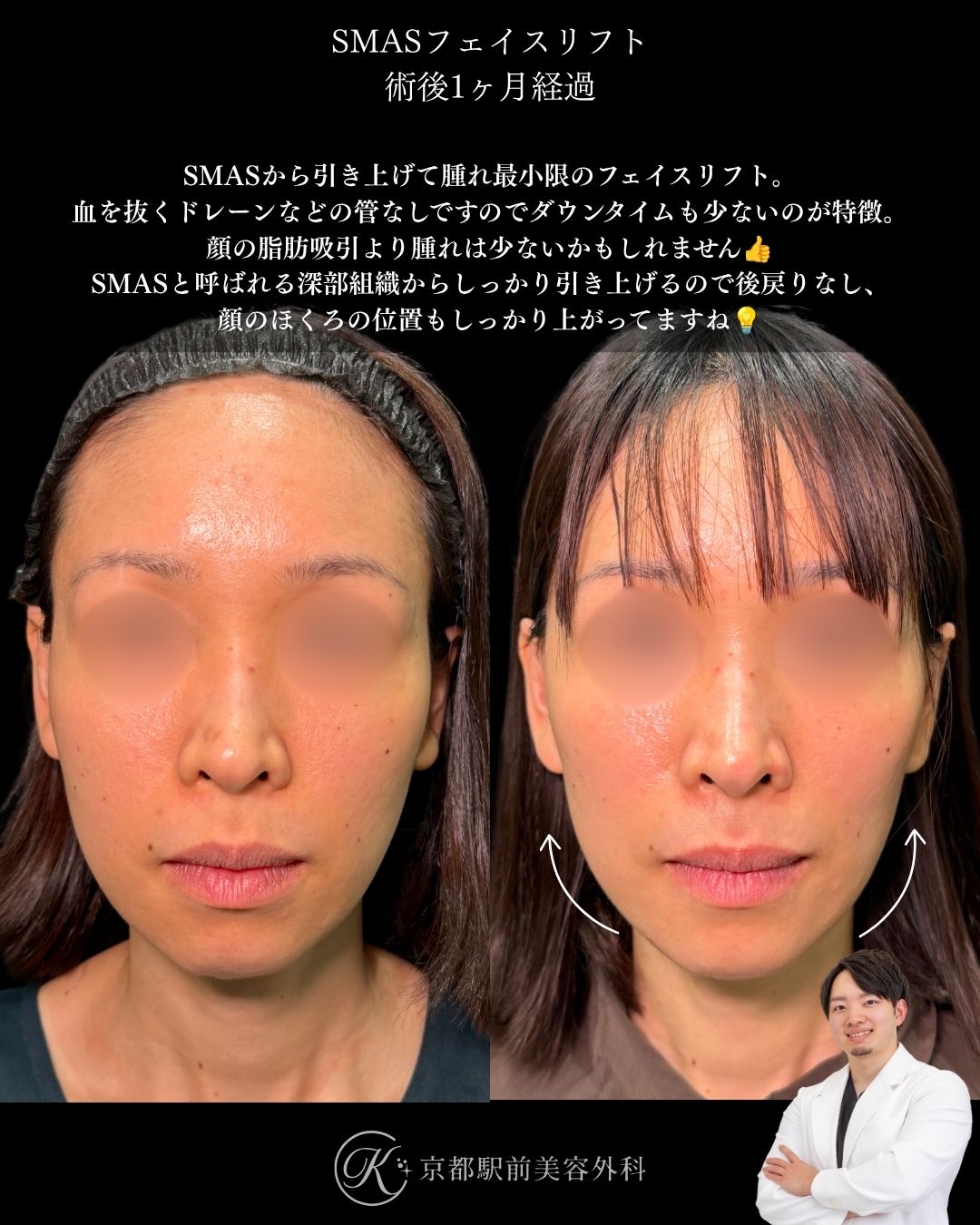30代のSMASフェイスリフト。京都駅前美容外科の症例写真。当院は滋賀、京都、大阪をはじめとした関西圏や全国から患者様にお越しいただいています。