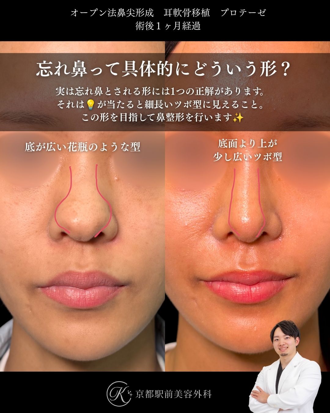 自然な忘れ鼻はこれ。鼻尖形成、耳軟骨移植、プロテーゼの症例。（京都駅前美容外科の症例）当院は滋賀、京都、大阪をはじめとした関西圏や全国から患者様にお越しいただいています。