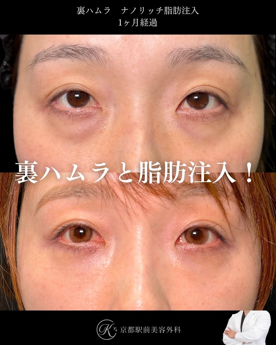 色クマも治す裏ハムラとナノリッチ脂肪注入の症例。京都駅前美容外科の症例画像。当院は滋賀、京都、大阪をはじめとした関西圏や全国から患者様にお越しいただいています。
