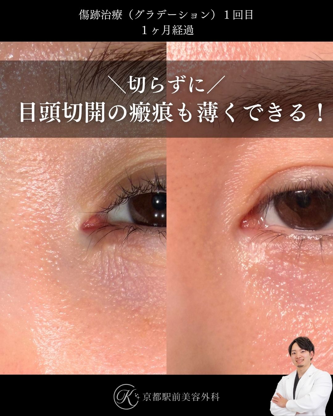傷跡治療・傷跡修正（グラデーション治療）の症例画像。目頭切開によりできた傷跡や瘢痕の写真など（京都駅前美容外科の症例写真）当院は滋賀、京都、大阪をはじめとした関西圏や全国から患者様にお越しいただいています。