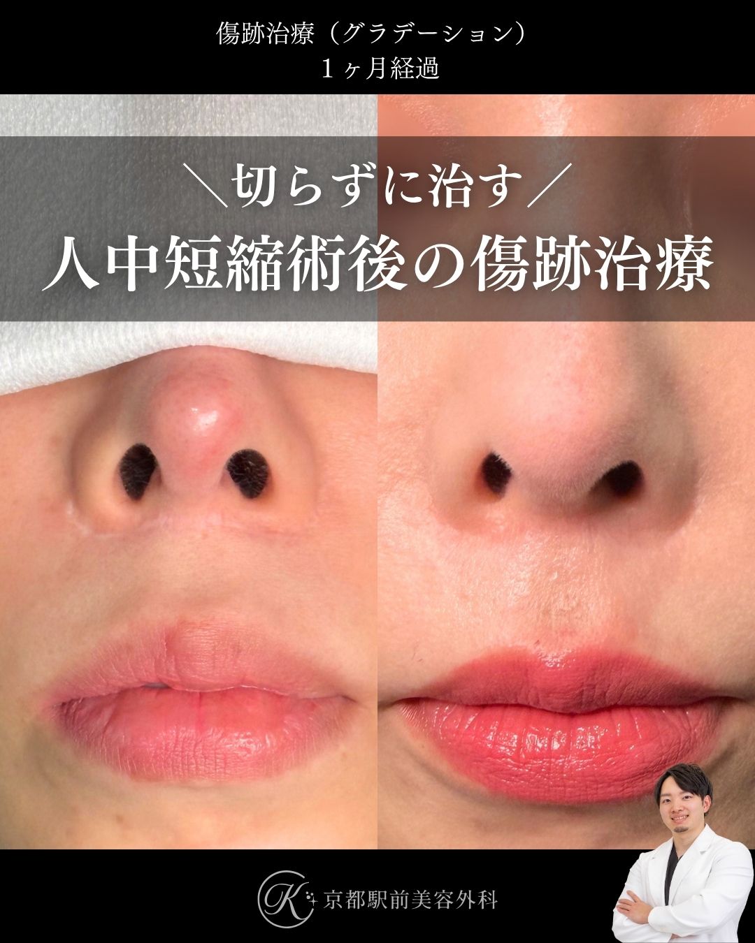 傷跡治療・傷跡修正(グラデーション治療)の症例画像。人中短縮によりできた傷跡の写真など(京都駅前美容外科の症例写真)当院は滋賀、京都、大阪をはじめとした関西圏や全国から患者様にお越しいただいています。