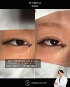 蒙古襞形成の術直後、京都駅前美容外科の症例写真。当院は滋賀、京都、大阪をはじめとした関西圏や全国から患者様にお越しいただいています。