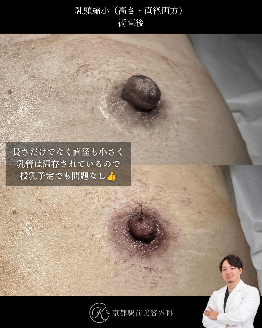 乳頭縮小の高さと直径の縮小の術直後写真。乳管温存。（京都駅前美容外科の症例写真）当院は滋賀、京都、大阪をはじめとした関西圏や全国から患者様にお越しいただいています。