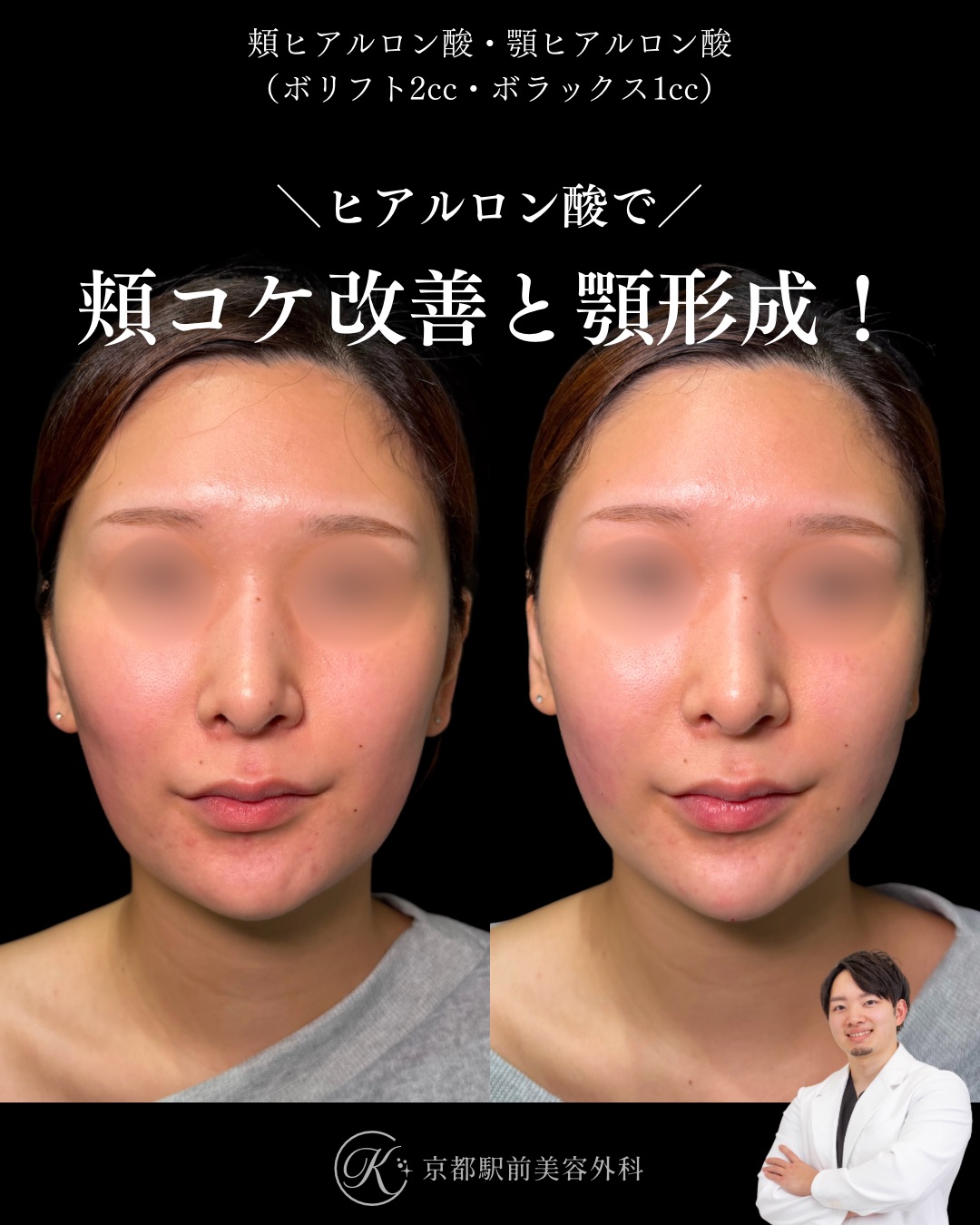 ヒアルロン酸で頬こけ改善とあごヒアルロン酸。京都駅前美容外科の症例画像。当院は滋賀、京都、大阪をはじめとした関西圏や全国から患者様にお越しいただいています。