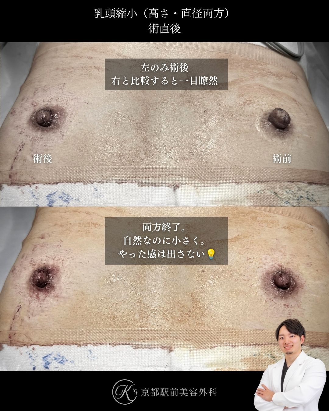 乳頭縮小の高さと直径の縮小の術直後写真。乳管温存。（京都駅前美容外科の症例写真）当院は滋賀、京都、大阪をはじめとした関西圏や全国から患者様にお越しいただいています。