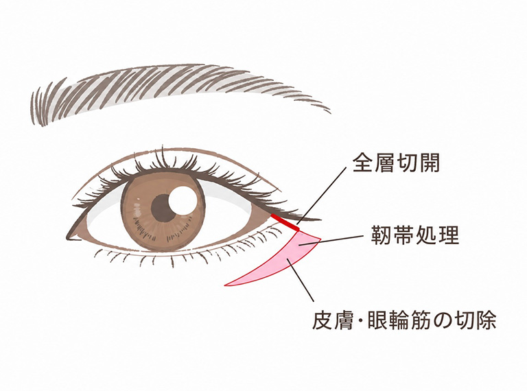 タレ目尻切開とは