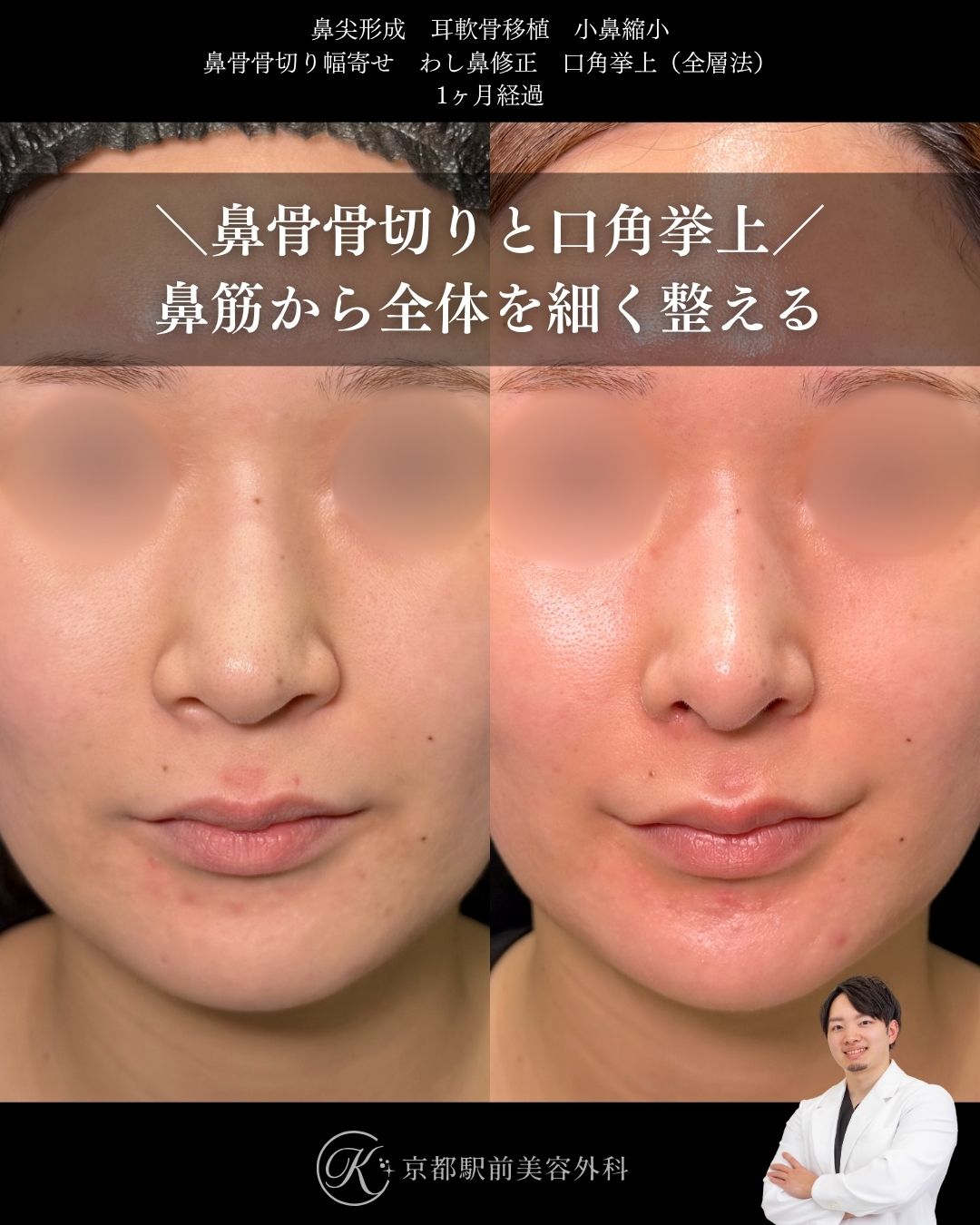 ラウンド型のお鼻を作る鼻整形と口角挙上。鼻尖形成・耳軟骨移植・小鼻縮小・鼻骨骨切り幅寄せ・わし鼻修正・口角挙上の1ヶ月経過写真(京都駅前美容外科の鼻整形症例)当院は滋賀、京都、大阪をはじめとした関西圏や全国から患者様にお越しいただいています。