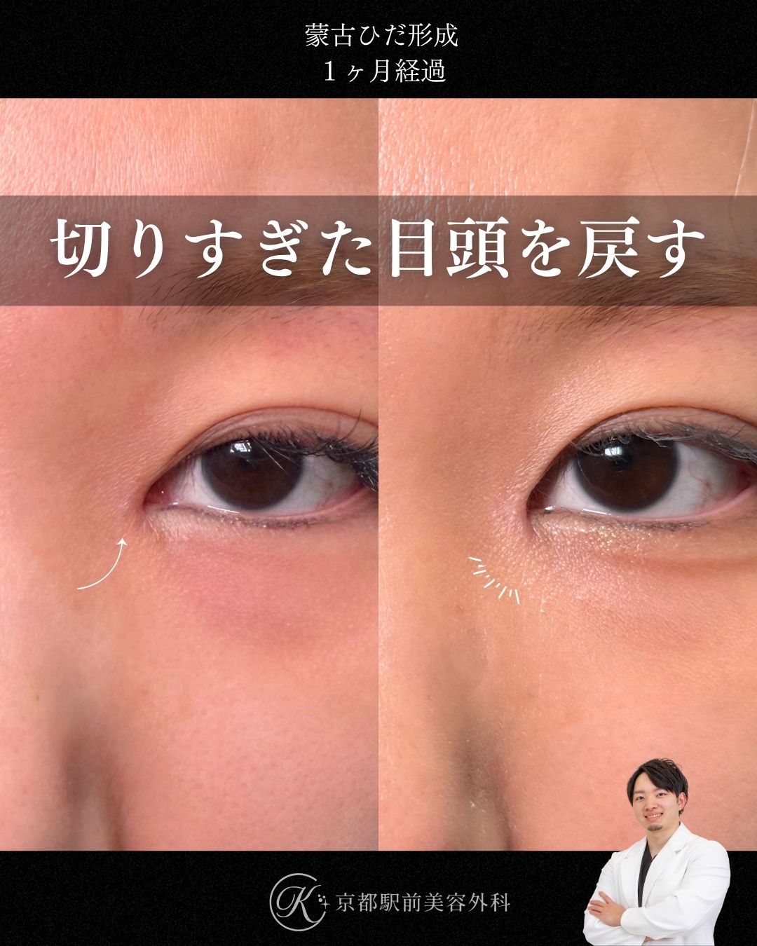 蒙古ひだ形成(逆Z法)の症例写真。京都駅前美容外科の症例画像。当院は滋賀、京都、大阪をはじめとした関西圏や全国から患者様にお越しいただいています。