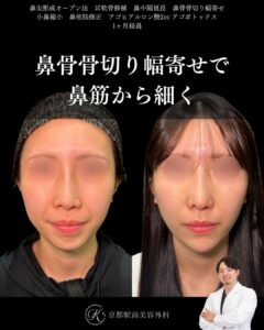 鼻尖形成、耳軟骨移植、鼻中隔延長、鼻骨骨切り幅寄せ、小鼻縮小、他院修正、顎ヒアルロン酸など（京都駅前美容外科の症例）当院は滋賀、京都、大阪をはじめとした関西圏や全国から患者様にお越しいただいています。