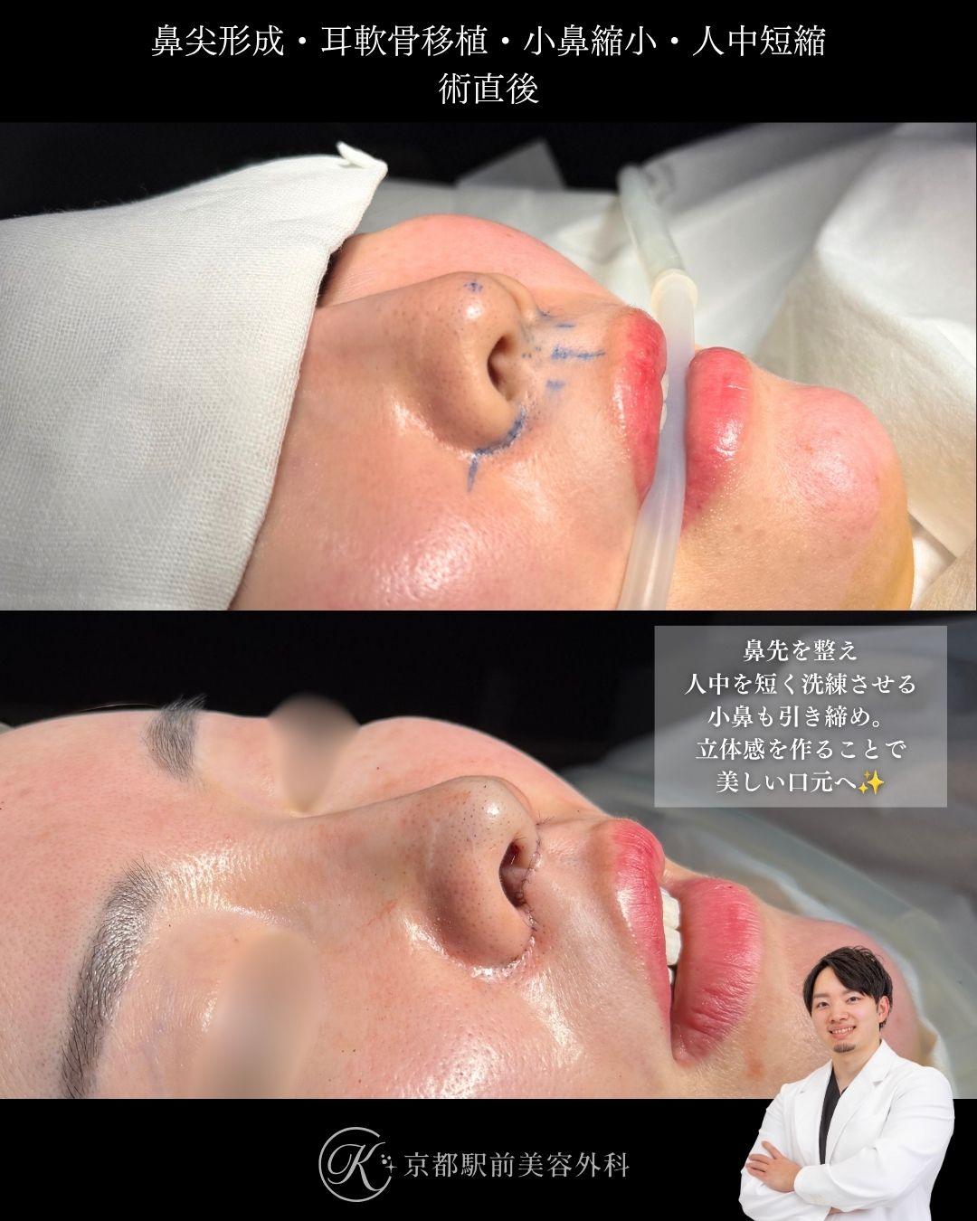 クローズ法による鼻尖形成、耳軟骨移植、小鼻縮小、人中短縮の症例。京都駅前美容外科の症例画像。当院は滋賀、京都、大阪をはじめとした関西圏や全国から患者様にお越しいただいています。