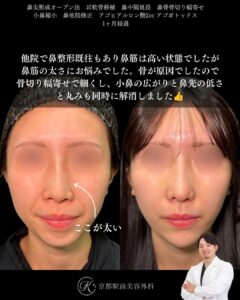 鼻尖形成、耳軟骨移植、鼻中隔延長、鼻骨骨切り幅寄せ、小鼻縮小、他院修正、顎ヒアルロン酸など（京都駅前美容外科の症例）当院は滋賀、京都、大阪をはじめとした関西圏や全国から患者様にお越しいただいています。