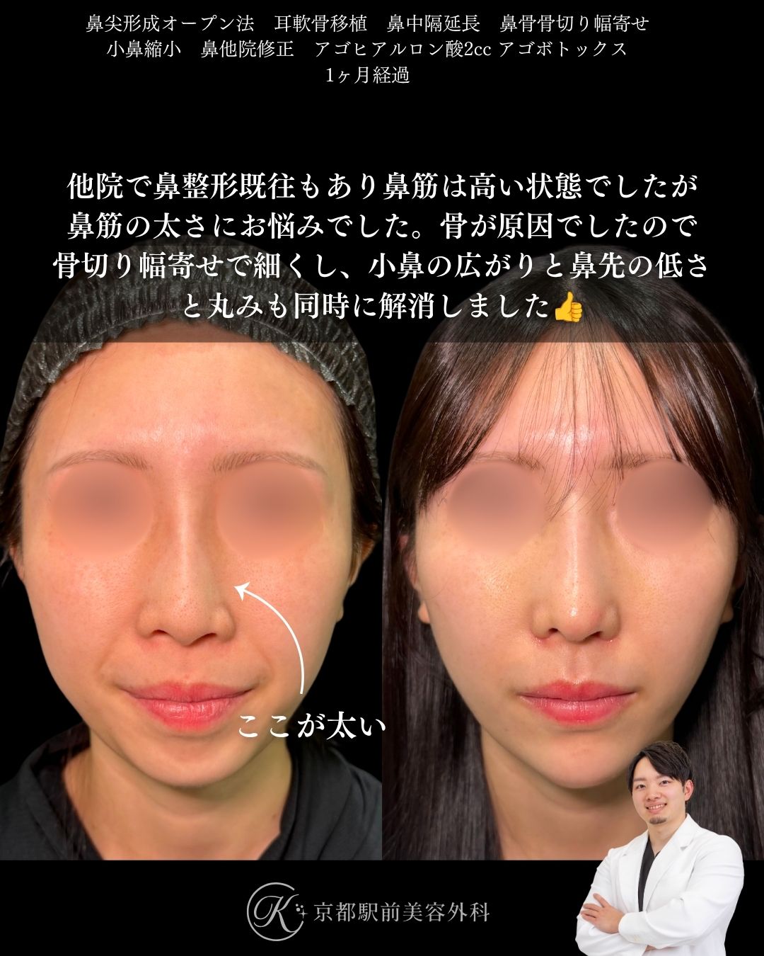 鼻尖形成、耳軟骨移植、鼻中隔延長、鼻骨骨切り幅寄せ、小鼻縮小、他院修正、顎ヒアルロン酸など（京都駅前美容外科の症例）当院は滋賀、京都、大阪をはじめとした関西圏や全国から患者様にお越しいただいています。
