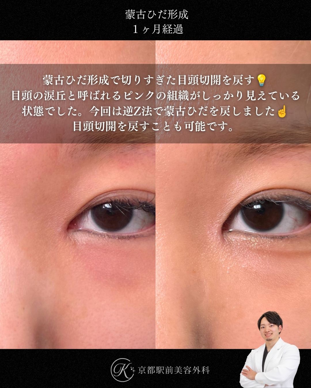蒙古ひだ形成（逆Z法）の症例写真。京都駅前美容外科の症例画像。当院は滋賀、京都、大阪をはじめとした関西圏や全国から患者様にお越しいただいています。