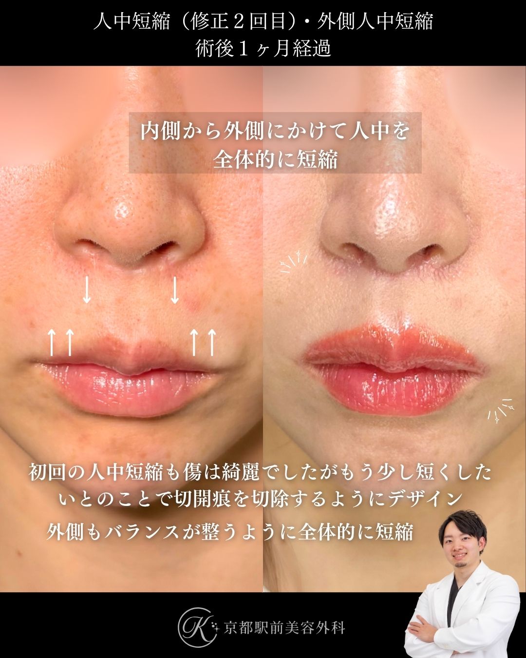 ２回目の人中短縮（修正）、外側人中短縮の症例。京都駅前美容外科の症例画像。当院は滋賀、京都、大阪をはじめとした関西圏や全国から患者様にお越しいただいています。