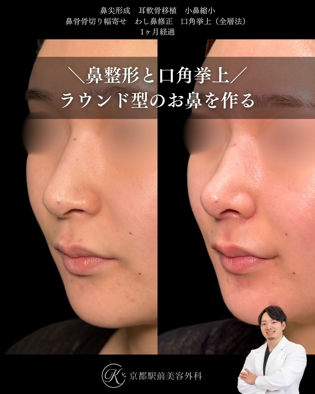 ラウンド型のお鼻を作る鼻整形と口角挙上。鼻尖形成・耳軟骨移植・小鼻縮小・鼻骨骨切り幅寄せ・わし鼻修正・口角挙上の1ヶ月経過写真(京都駅前美容外科の鼻整形症例)当院は滋賀、京都、大阪をはじめとした関西圏や全国から患者様にお越しいただいています。