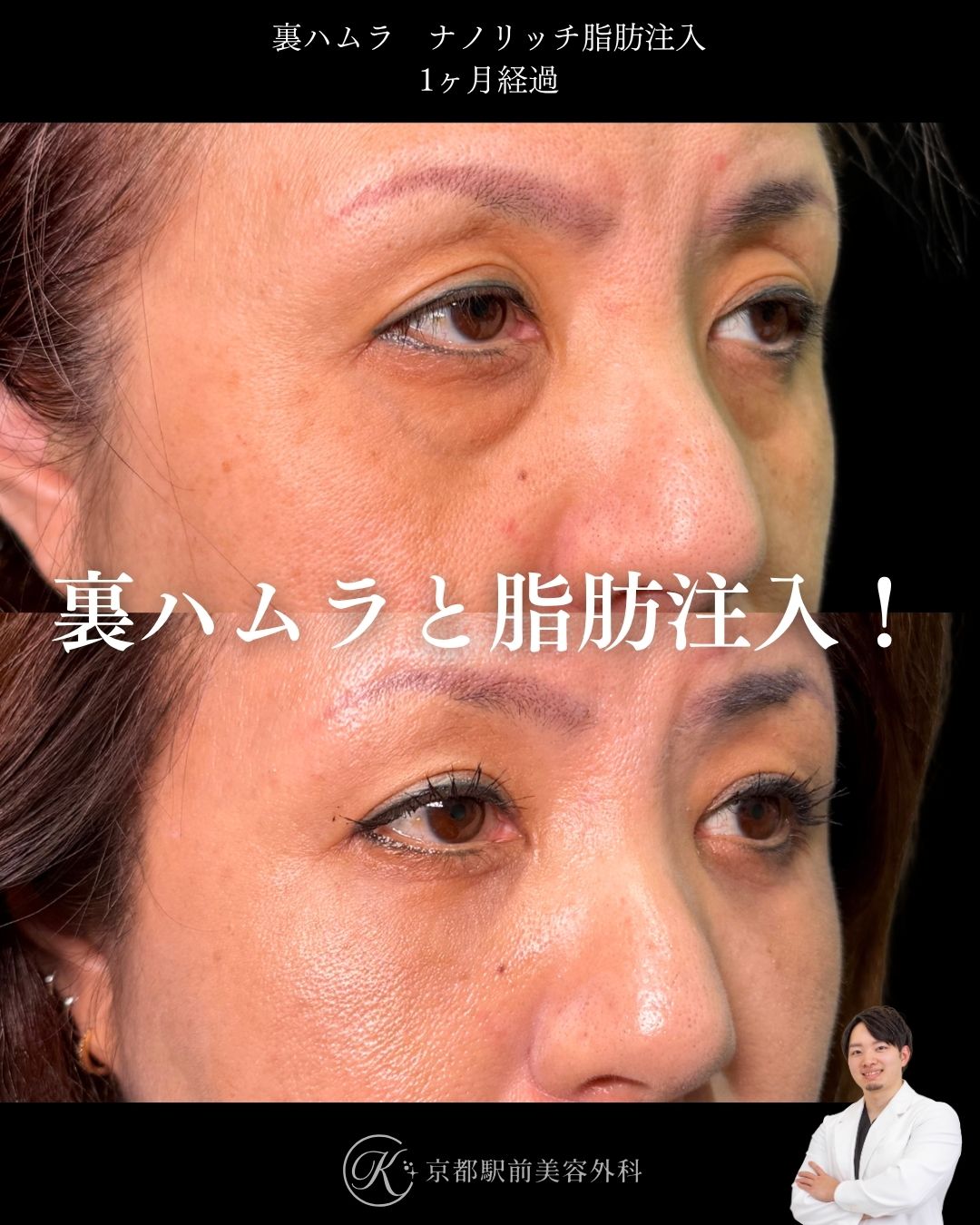 色クマも治す裏ハムラとナノリッチ脂肪注入の症例。京都駅前美容外科の症例画像。当院は滋賀、京都、大阪をはじめとした関西圏や全国から患者様にお越しいただいています。
