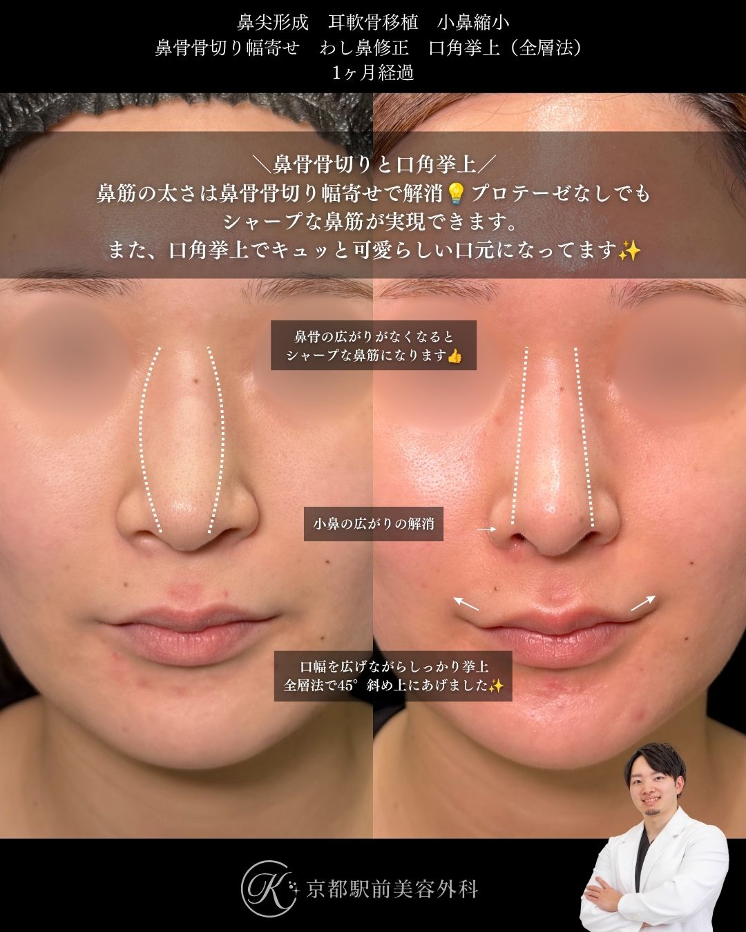 ラウンド型のお鼻を作る鼻整形と口角挙上。鼻尖形成・耳軟骨移植・小鼻縮小・鼻骨骨切り幅寄せ・わし鼻修正・口角挙上の１ヶ月経過写真（京都駅前美容外科の鼻整形症例）当院は滋賀、京都、大阪をはじめとした関西圏や全国から患者様にお越しいただいています。