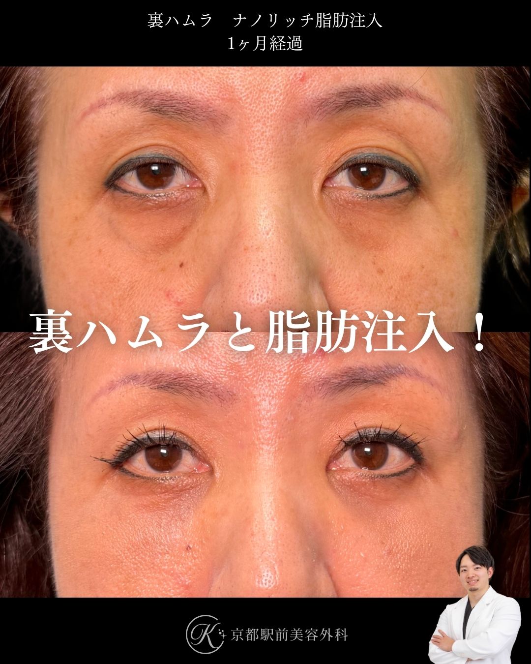 色クマも治す裏ハムラとナノリッチ脂肪注入の症例。京都駅前美容外科の症例画像。当院は滋賀、京都、大阪をはじめとした関西圏や全国から患者様にお越しいただいています。