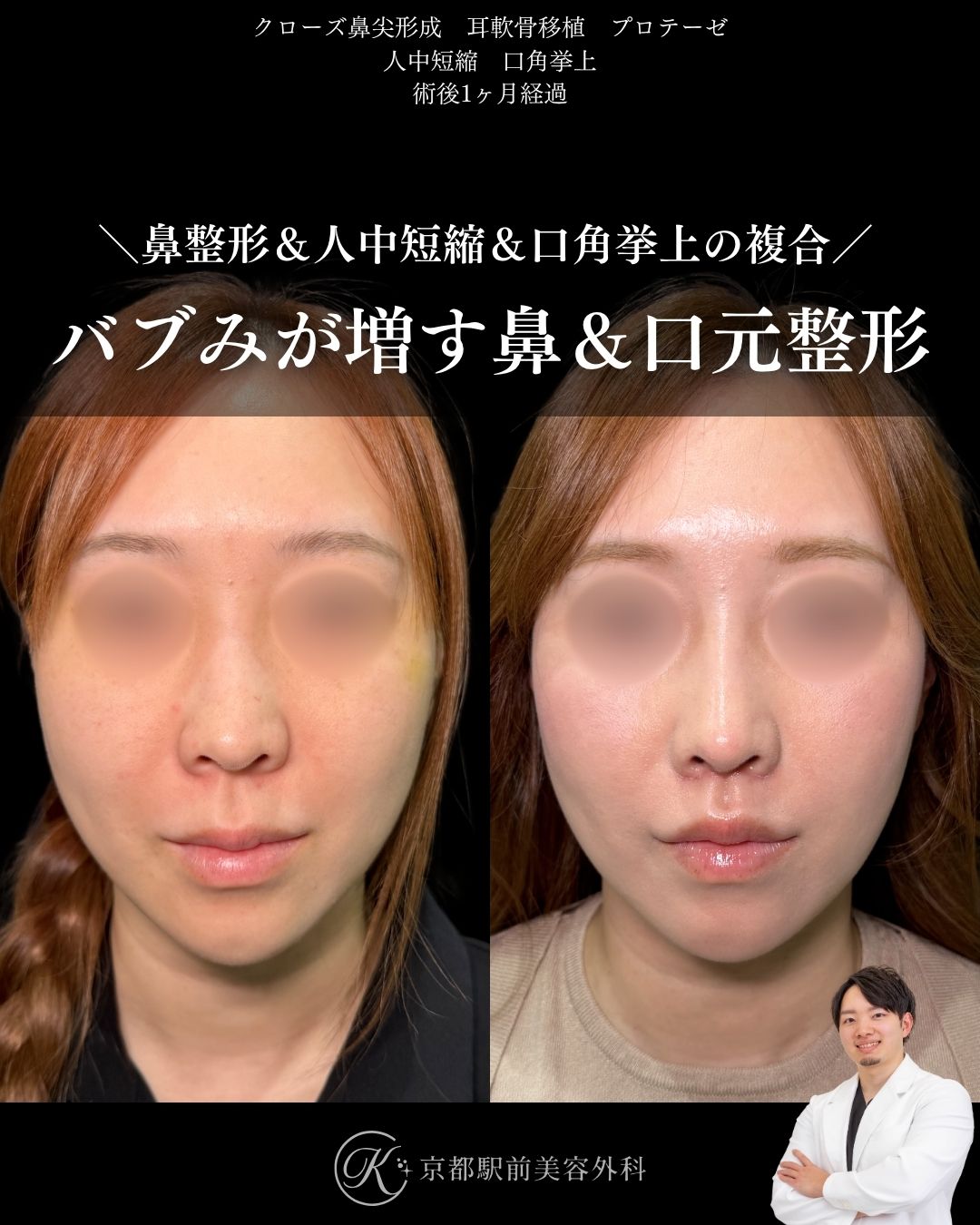 クローズ法による鼻尖形成、耳軟骨移植、プロテーゼ、人中短縮、口角挙上（全層法）の症例。京都駅前美容外科の症例画像。当院は滋賀、京都、大阪をはじめとした関西圏や全国から患者様にお越しいただいています。