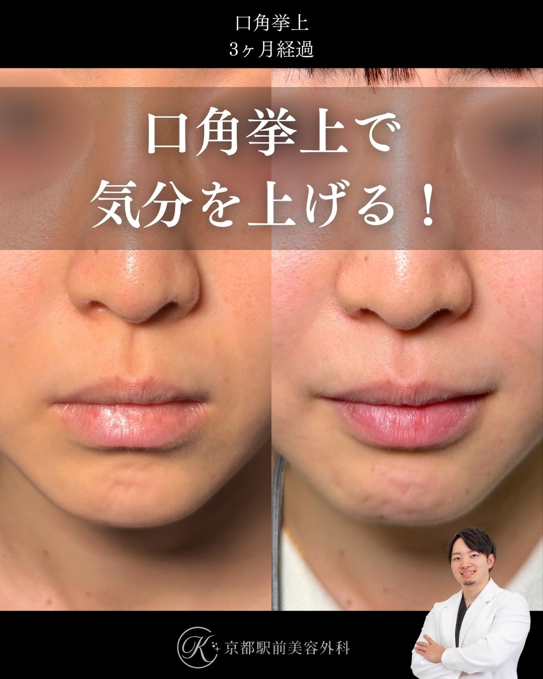 口角挙上（全層法）の症例。京都駅前美容外科の症例画像。当院は滋賀、京都、大阪をはじめとした関西圏や全国から患者様にお越しいただいています。