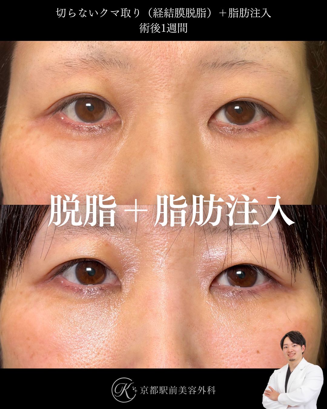 切らないクマ取り（経結膜脱脂）と色クマも治すナノリッチ脂肪注入の症例。京都駅前美容外科の症例画像。当院は滋賀、京都、大阪をはじめとした関西圏や全国から患者様にお越しいただいています。