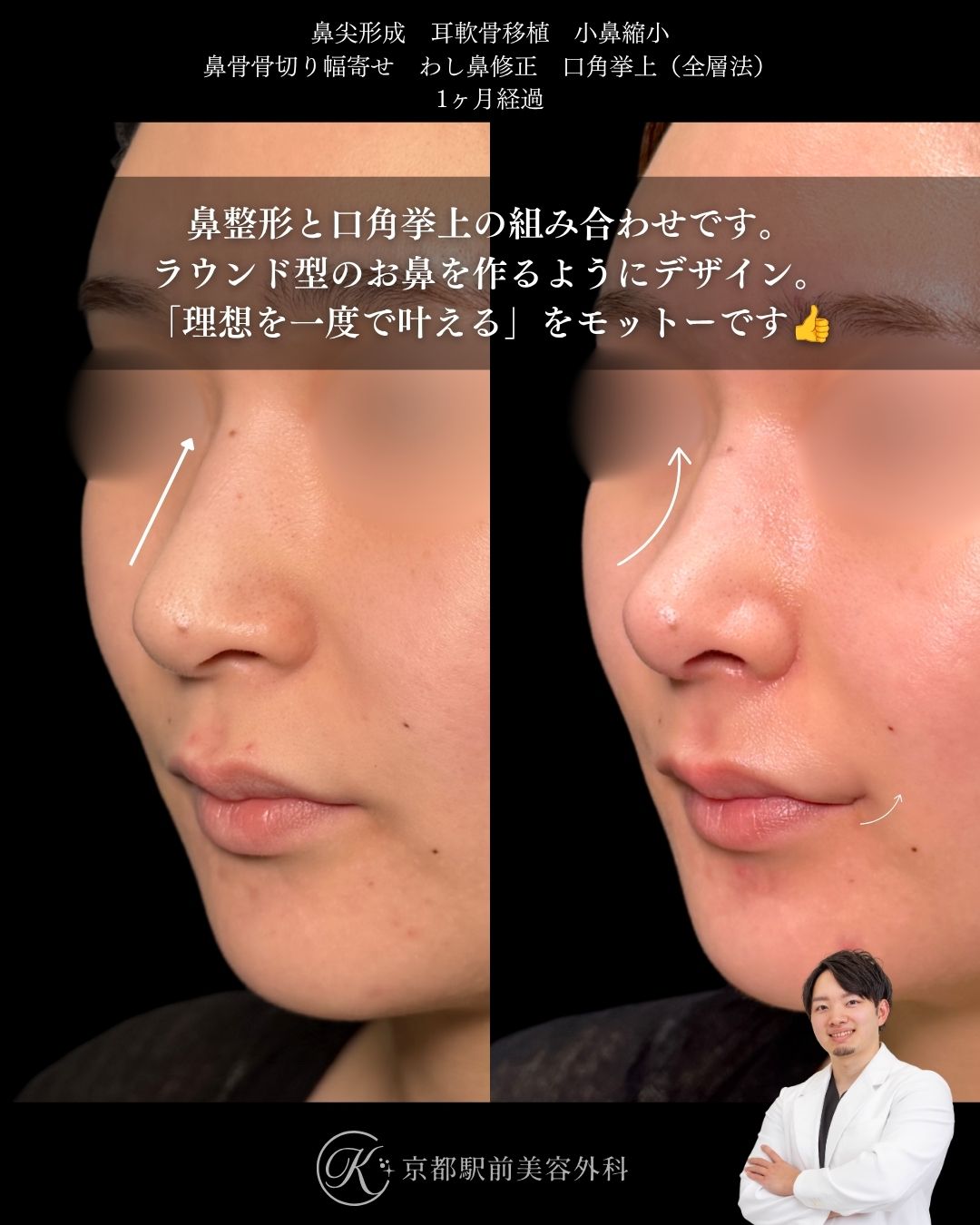 ラウンド型のお鼻を作る鼻整形と口角挙上。鼻尖形成・耳軟骨移植・小鼻縮小・鼻骨骨切り幅寄せ・わし鼻修正・口角挙上の１ヶ月経過写真（京都駅前美容外科の鼻整形症例）当院は滋賀、京都、大阪をはじめとした関西圏や全国から患者様にお越しいただいています。