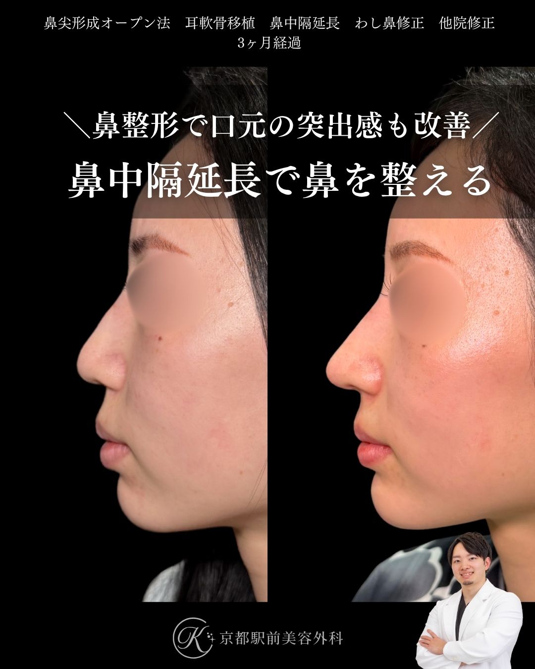 鼻尖形成、耳軟骨移植、鼻中隔延長、わし鼻修正、他院修正など(京都駅前美容外科の症例)当院は滋賀、京都、大阪をはじめとした関西圏や全国から患者様にお越しいただいています。