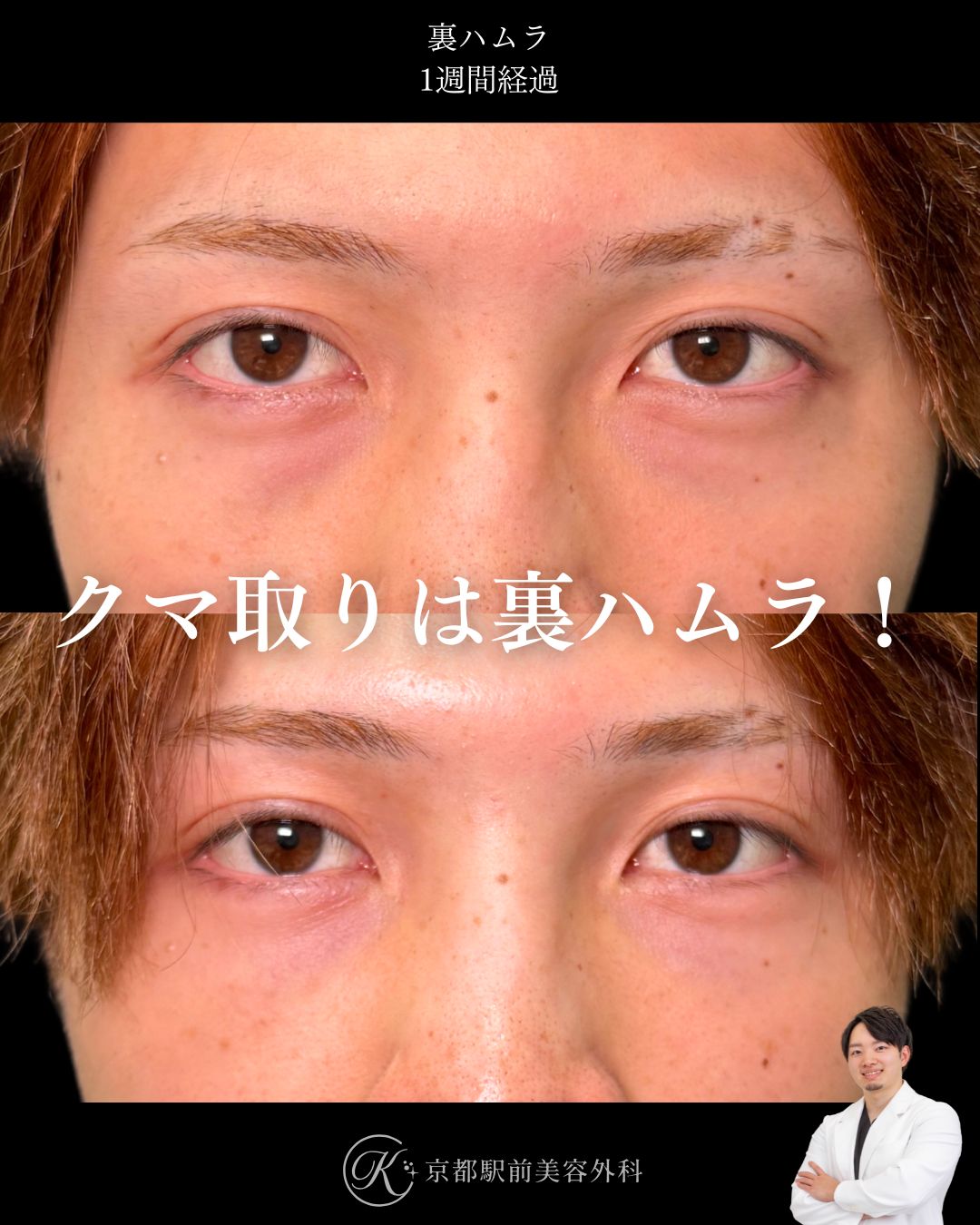 裏ハムラの症例。京都駅前美容外科の症例画像。当院は滋賀、京都、大阪をはじめとした関西圏や全国から患者様にお越しいただいています。