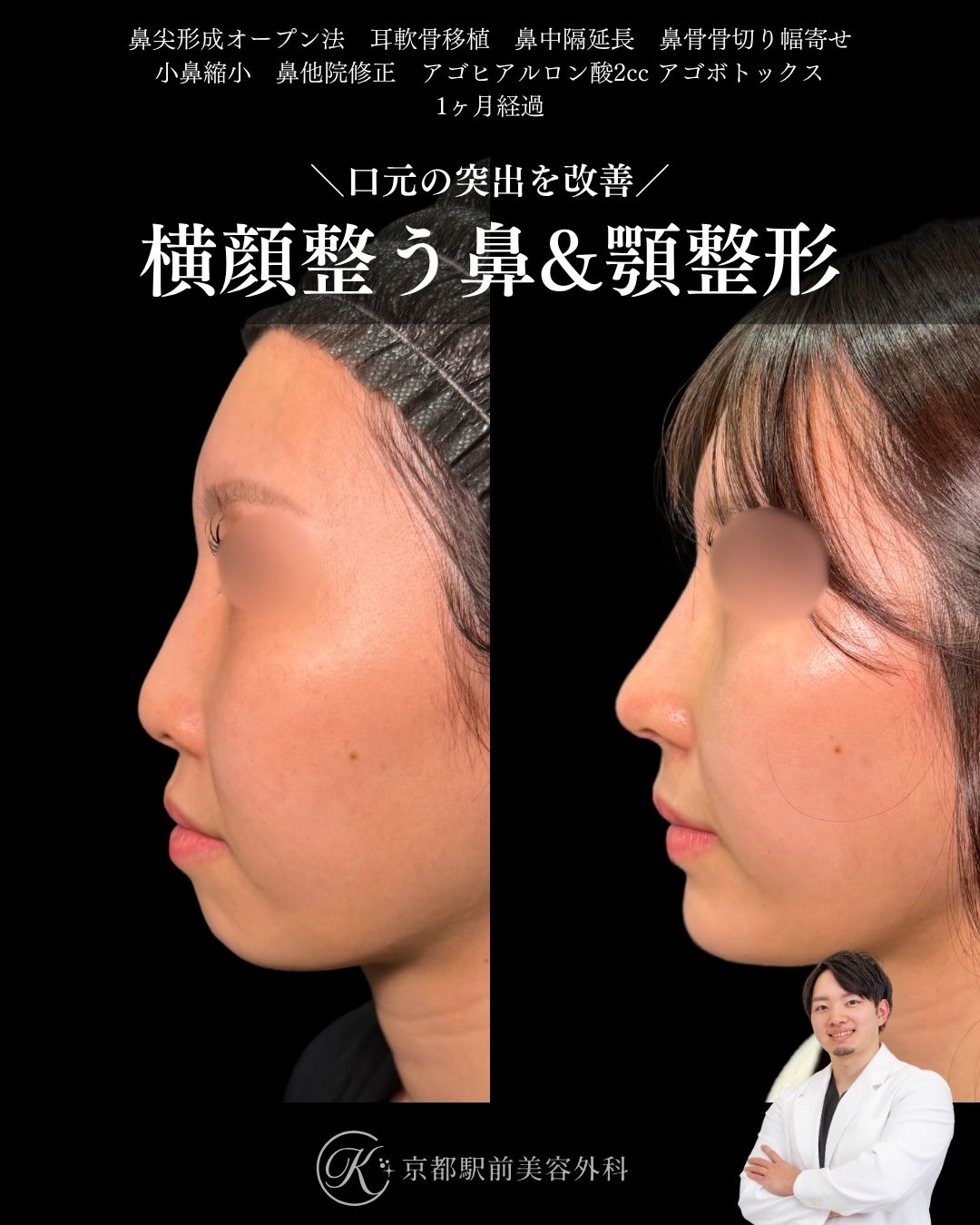 鼻尖形成、耳軟骨移植、鼻中隔延長、鼻骨骨切り幅寄せ、小鼻縮小、他院修正、顎ヒアルロン酸など(京都駅前美容外科の症例)当院は滋賀、京都、大阪をはじめとした関西圏や全国から患者様にお越しいただいています。
