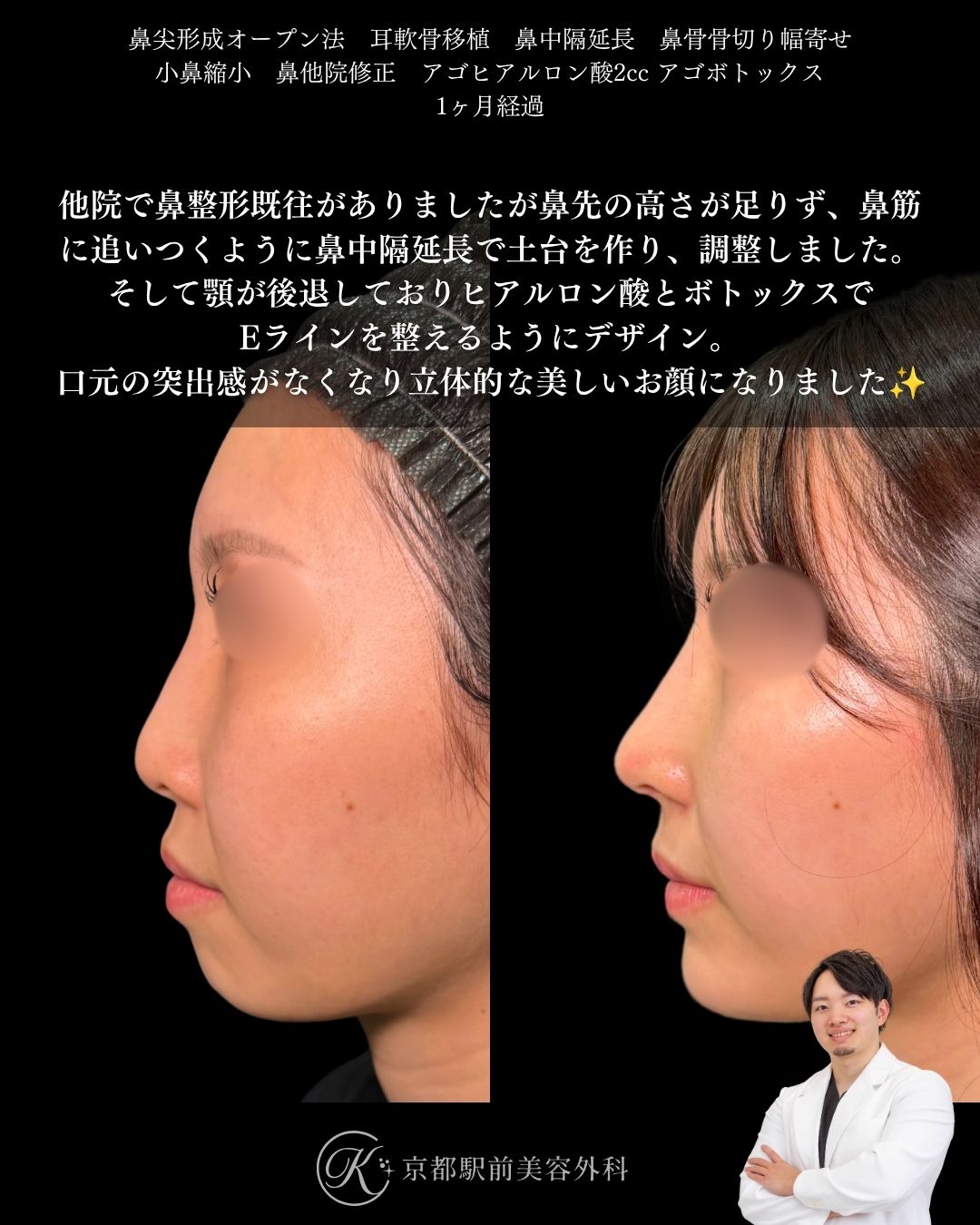 鼻尖形成、耳軟骨移植、鼻中隔延長、鼻骨骨切り幅寄せ、小鼻縮小、他院修正、顎ヒアルロン酸など（京都駅前美容外科の症例）当院は滋賀、京都、大阪をはじめとした関西圏や全国から患者様にお越しいただいています。