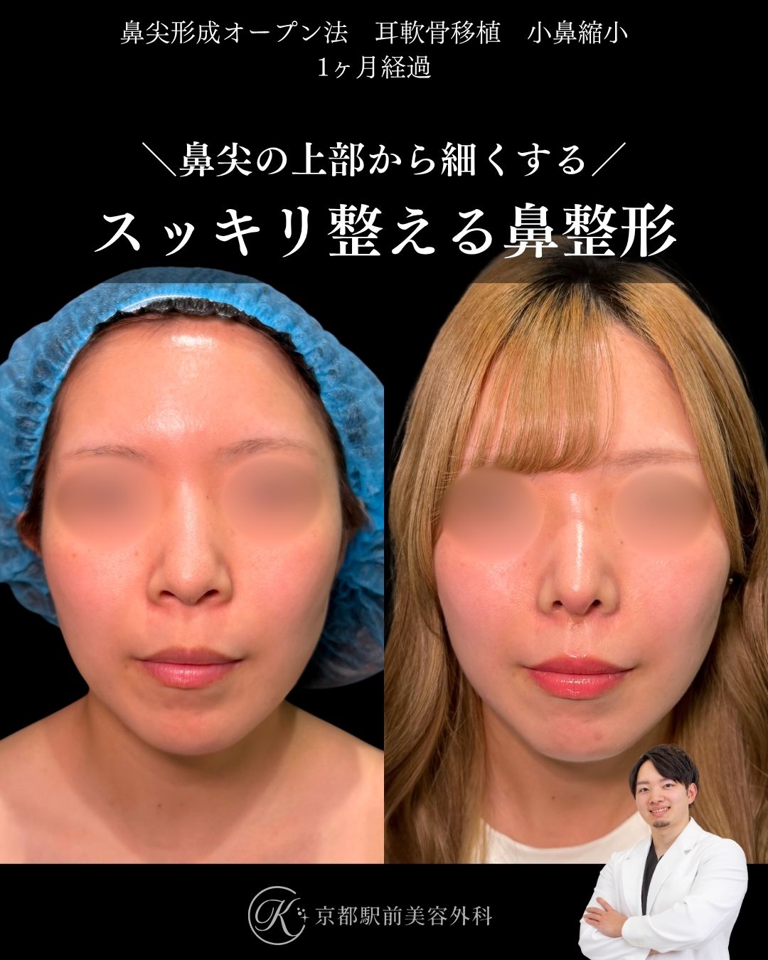 鼻尖形成、耳軟骨移植、小鼻縮小など(京都駅前美容外科の症例)当院は滋賀、京都、大阪をはじめとした関西圏や全国から患者様にお越しいただいています。